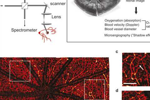 The plot thickens with Optic Neuritis