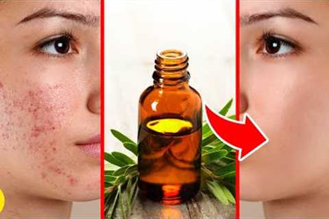 9 Health Benefits Of Tea Tree Oil That Can Help Your Skin, Acne & Dandruff
