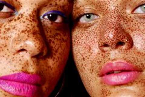 Hyperpigmentation treatment: how to handle dark spots and pigmentation at home