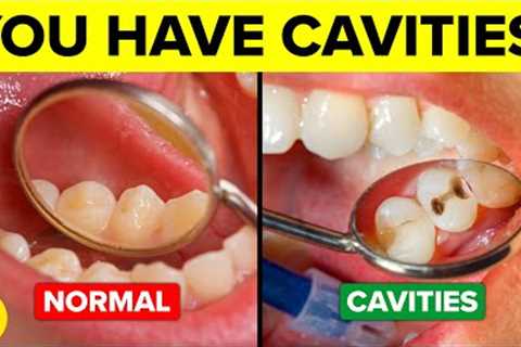 You’re Getting Cavities And You Don’t Even Know It!