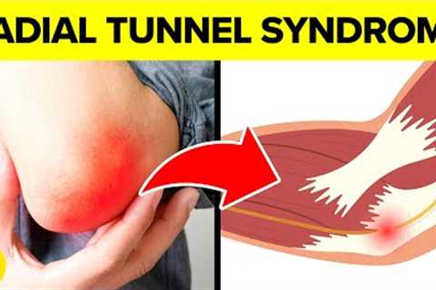 What Is Radial Tunnel Syndrome? | Symptoms, Diagnosis & Treatment