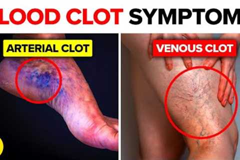 Symptoms Of Blood Clots You Must Not Ignore | Dangers Of Blood Clots