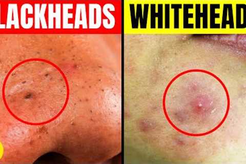 Blackheads Vs. Whiteheads: What’s The Difference & How To Get Rid Of Them