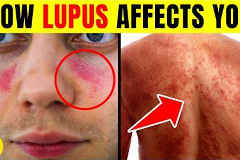 6 Ways Lupus Can Affect Your Body