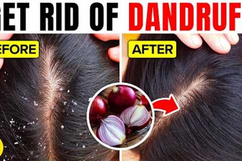 16 Super Effective Ways To Get Rid Of Dandruff Naturally
