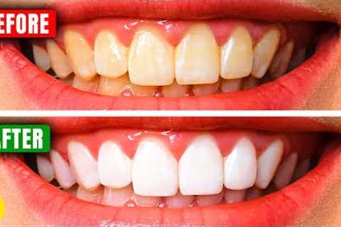 The Pros And Cons Of Teeth Whitening Strips