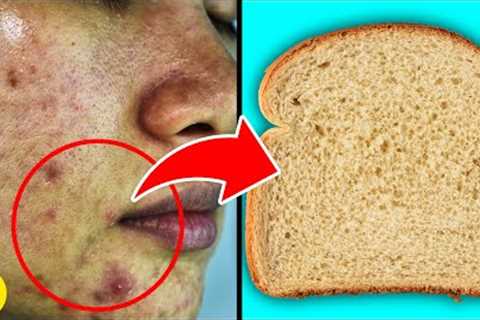 9 Foods To AVOID If You Don’t Want CLOGGED Pores | Remove Acne, Pimples
