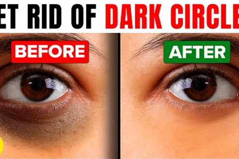 Get Rid Of Dark Circles Permanently With These 8 Effective Tips