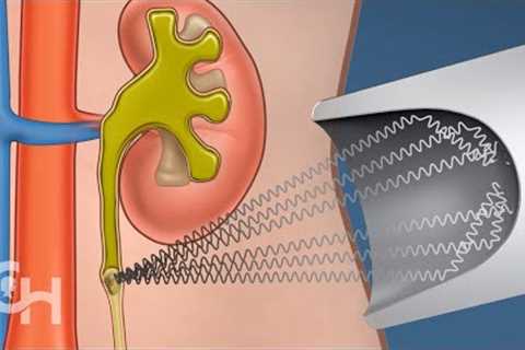 Shockwave Lithotripsy Surgery for Kidney Stones in Children