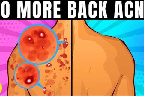 14 Ways To Get Rid Of Back Acne Once And For All